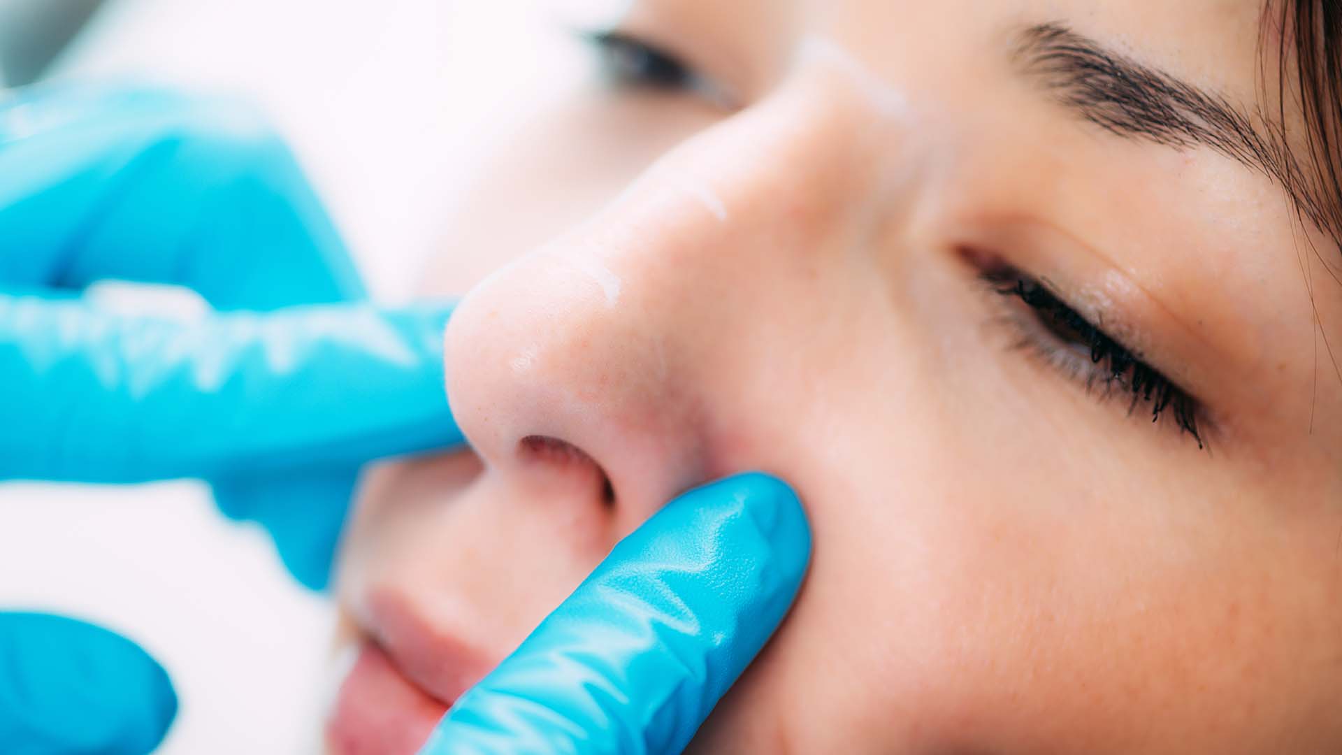 rhinoplastik_vorher_nachher_tuerkei
