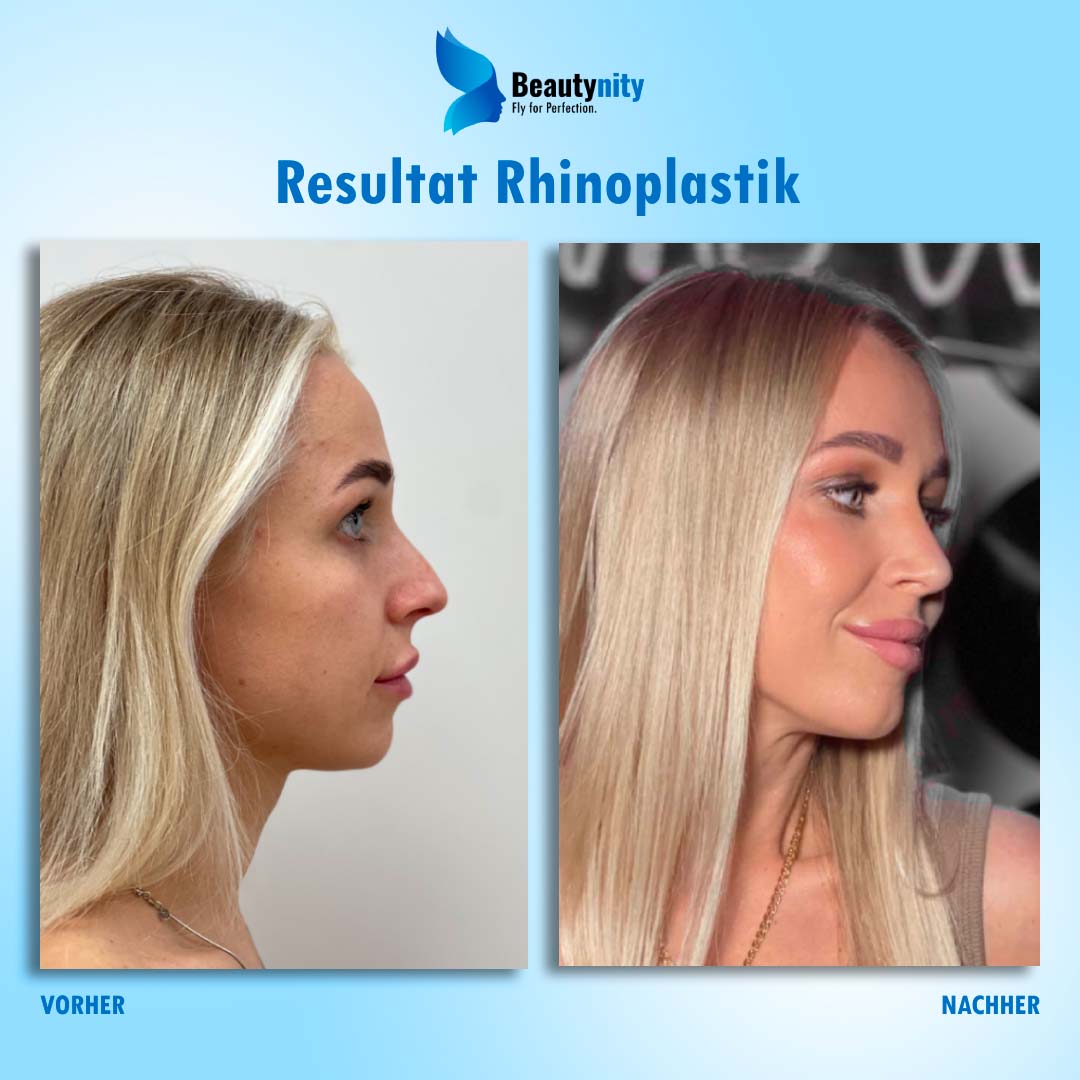 rhinoplastik_vorher_nachher_tuerkei